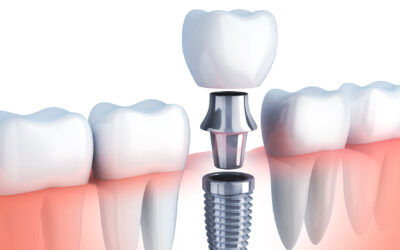 L’implantologia dentale, di che cosa si tratta?