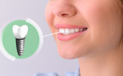 Impianti dentali, come avviene il processo di osteointegrazione?