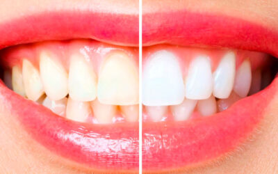 Igiene dentale: che cosa significa? E cosa fa un igienista dentale?